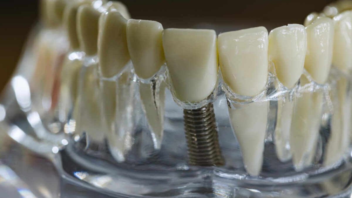 Crown and Bridge Implants: The Ultimate Solution for Missing Teeth