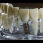 Crown and Bridge Implants: The Ultimate Solution for Missing Teeth