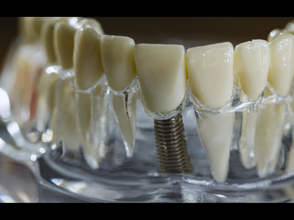 Crown and Bridge Implants: The Ultimate Solution for Missing Teeth